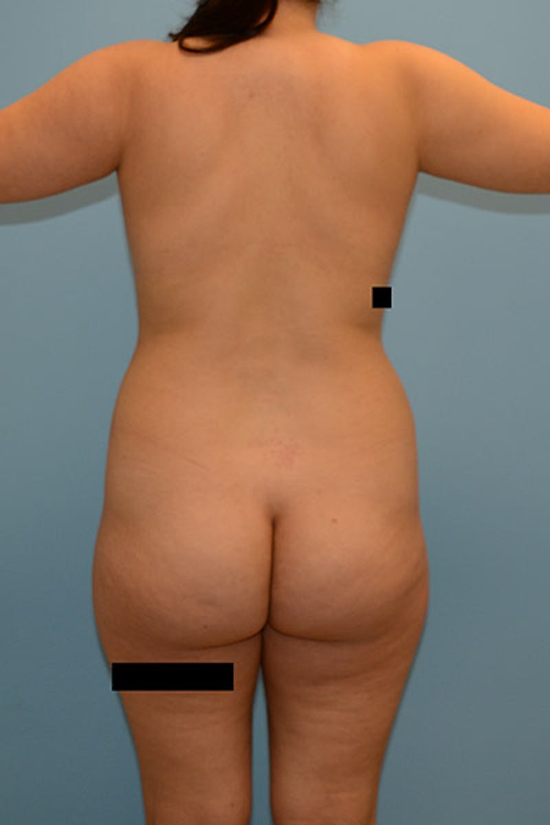 Brazilian Butt Lift Before & After Gallery - Patient 12917471 - Image 1