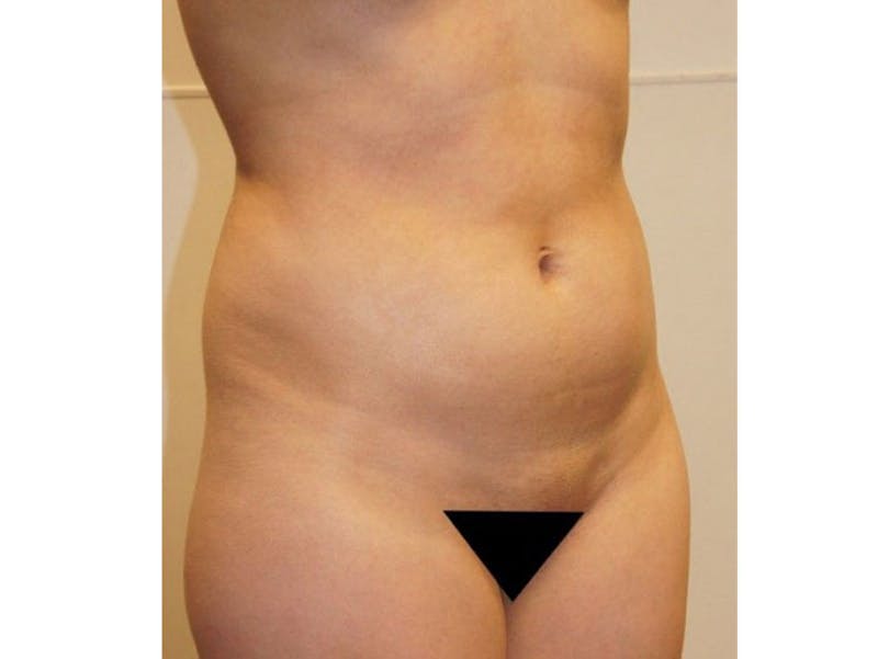 Liposuction Before & After Gallery - Patient 12917472 - Image 3