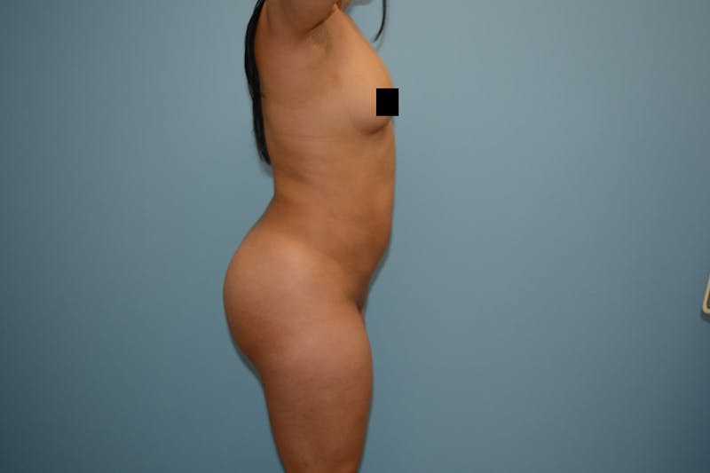 Brazilian Butt Lift Before & After Gallery - Patient 12936004 - Image 4