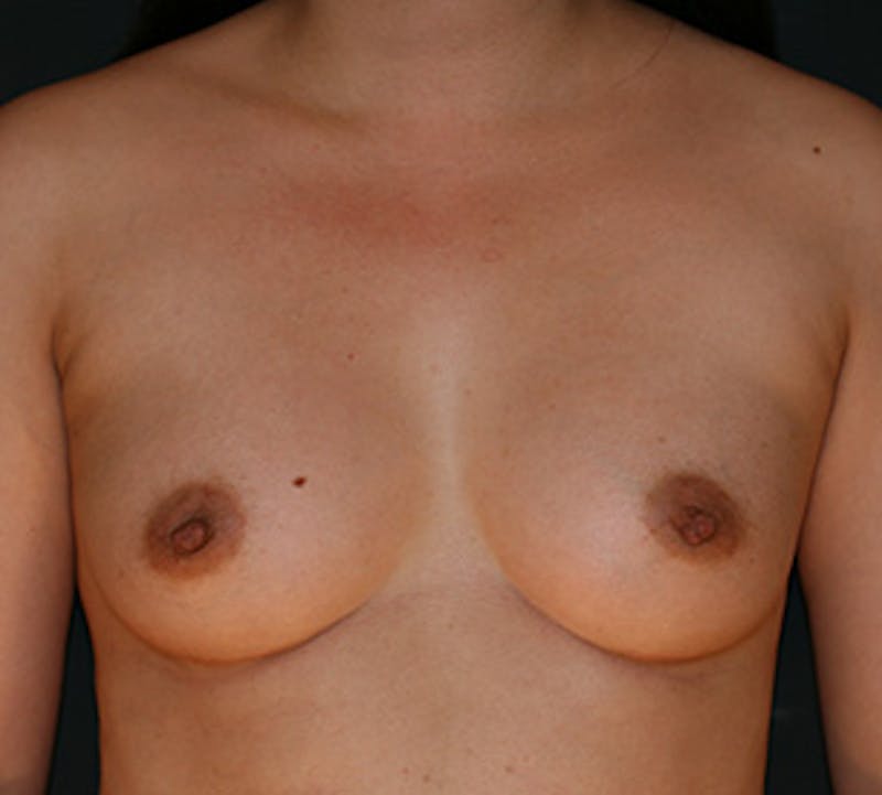 Breast Augmentation Before & After Gallery - Patient 132758068 - Image 2