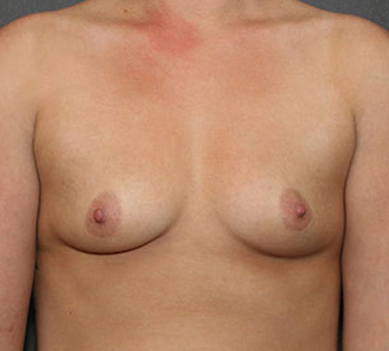 Breast Augmentation Before & After Gallery - Patient 132759185 - Image 1