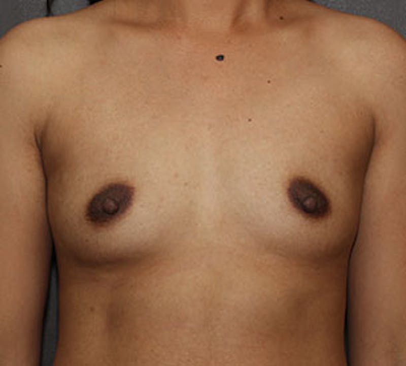Breast Augmentation Before & After Gallery - Patient 132759194 - Image 1