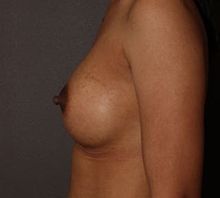 Breast Augmentation Before & After Gallery - Patient 132759194 - Image 10