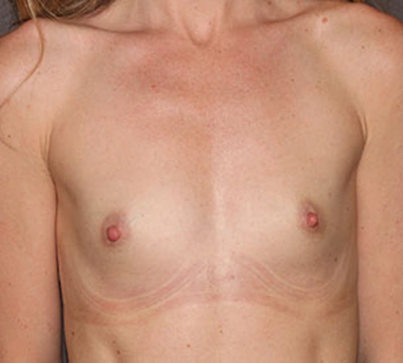 Breast Augmentation Before & After Gallery - Patient 132759203 - Image 1