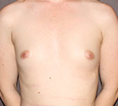 Breast Augmentation Before & After Gallery - Patient 132759836 - Image 1