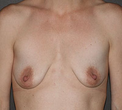 Breast Augmentation Before & After Gallery - Patient 132759855 - Image 1