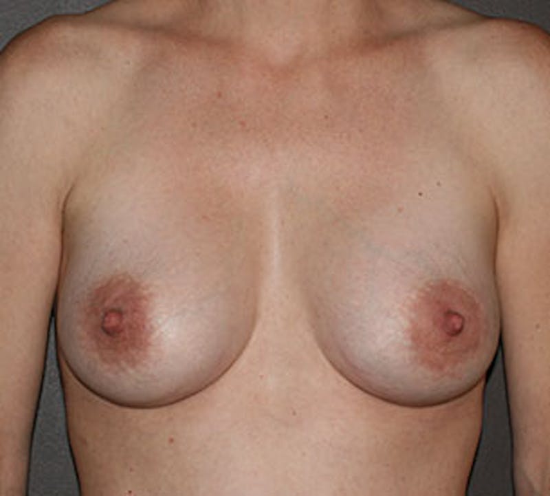 Breast Augmentation Before & After Gallery - Patient 132759855 - Image 2