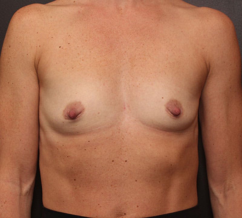 Breast Augmentation