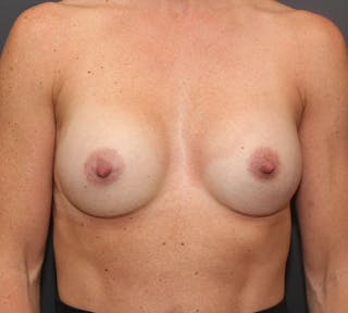 Breast Augmentation Before & After Gallery - Patient 400196 - Image 2