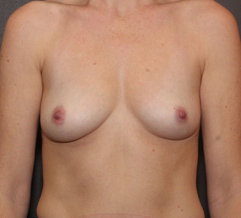 Breast Augmentation Before & After Gallery - Patient 158294 - Image 1