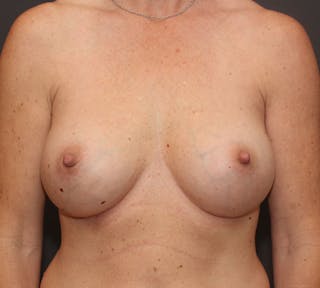 Breast Augmentation Before & After Gallery - Patient 366199 - Image 2