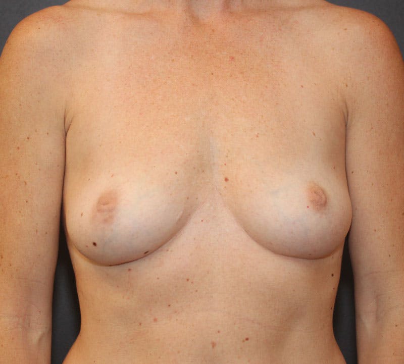 Nipple Inversion Before & After Gallery - Patient 244702 - Image 1