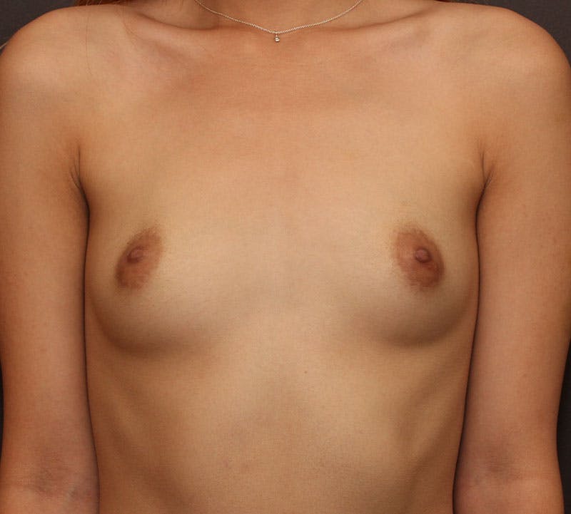 Breast Augmentation Before & After Gallery - Patient 172807 - Image 1