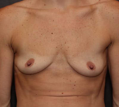 Breast Augmentation Before & After Gallery - Patient 228510 - Image 1