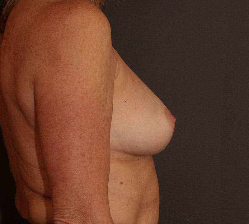 Breast Augmentation Before & After Gallery - Patient 366313 - Image 5