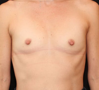 Breast Augmentation Before & After Gallery - Patient 368954 - Image 1
