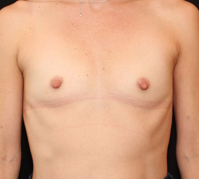 Breast Augmentation Before & After Gallery - Patient 368954 - Image 1