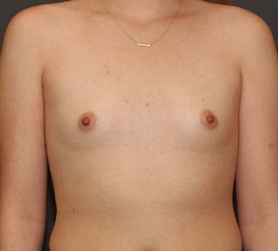 Breast Augmentation Before & After Gallery - Patient 111994 - Image 1