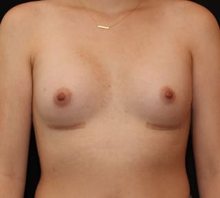 Breast Augmentation Before & After Gallery - Patient 111994 - Image 2