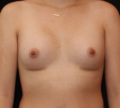 Breast Augmentation Before & After Gallery - Patient 111994 - Image 2