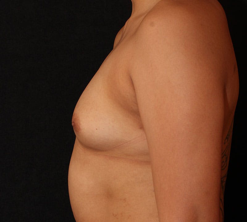 Breast Augmentation Before & After Gallery - Patient 318518 - Image 7