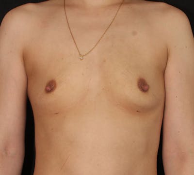 Breast Augmentation Before & After Gallery - Patient 318492 - Image 1