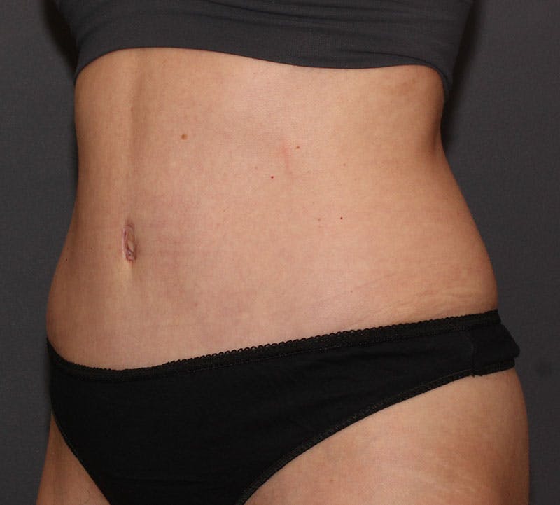 Tummy Tuck Before & After Gallery - Patient 393654 - Image 10