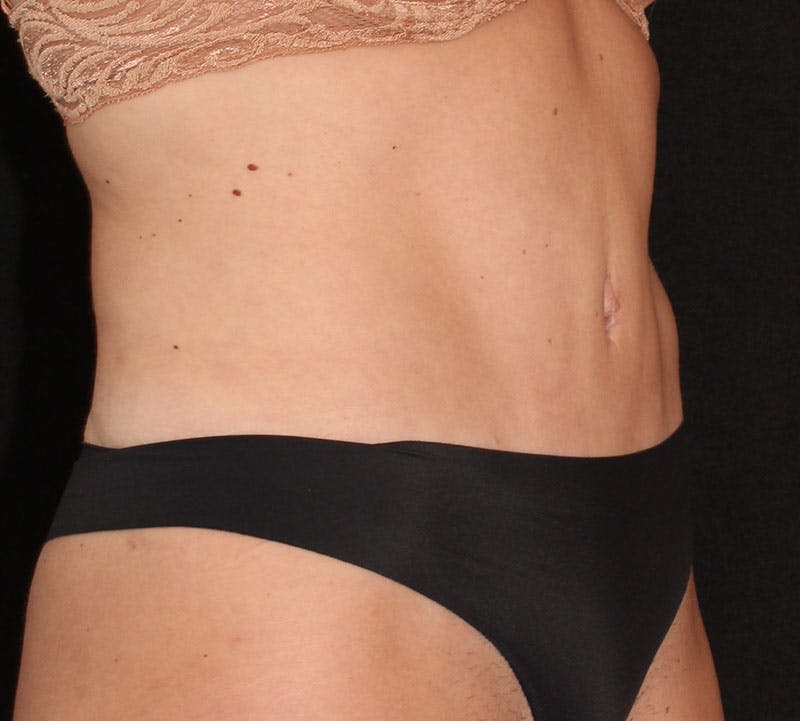 Tummy Tuck Before & After Gallery - Patient 806182 - Image 4
