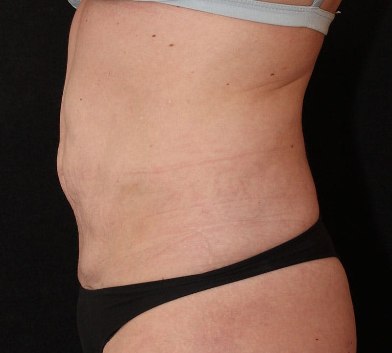 Tummy Tuck Before & After Gallery - Patient 806182 - Image 7