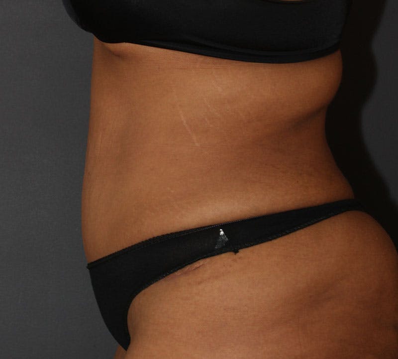 Tummy Tuck Before & After Gallery - Patient 160370 - Image 8