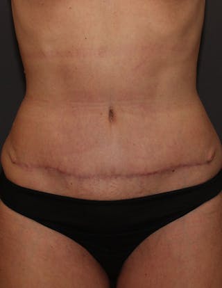 Mommy Makeover Before & After Gallery - Patient 255877 - Image 4