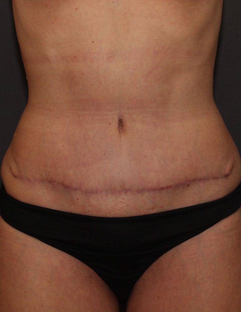 Mommy Makeover Before & After Gallery - Patient 255877 - Image 4
