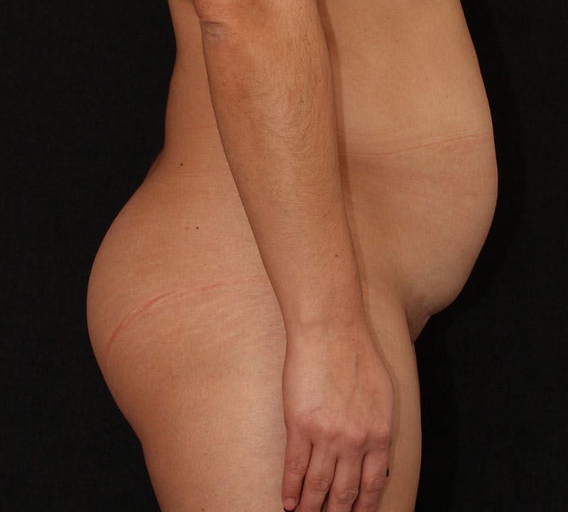 Brazilian Butt Lift Before & After Gallery - Patient 913037 - Image 5