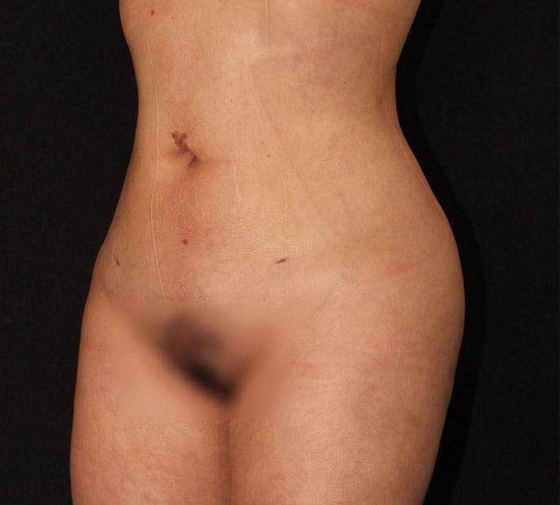 Brazilian Butt Lift Before & After Gallery - Patient 391104 - Image 12