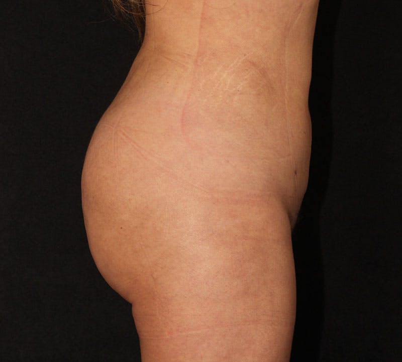Brazilian Butt Lift Before & After Gallery - Patient 391104 - Image 6
