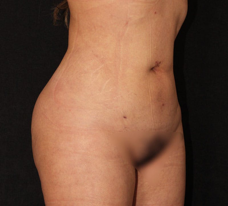 Brazilian Butt Lift Before & After Gallery - Patient 391104 - Image 8