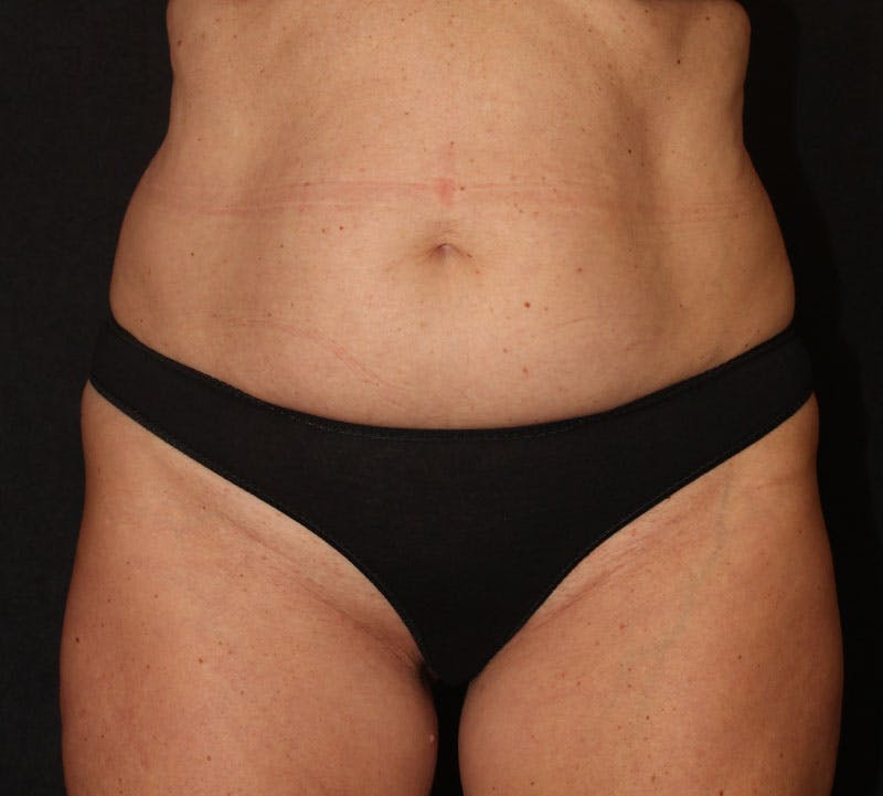Brazilian Butt Lift Before & After Gallery - Patient 320790 - Image 7
