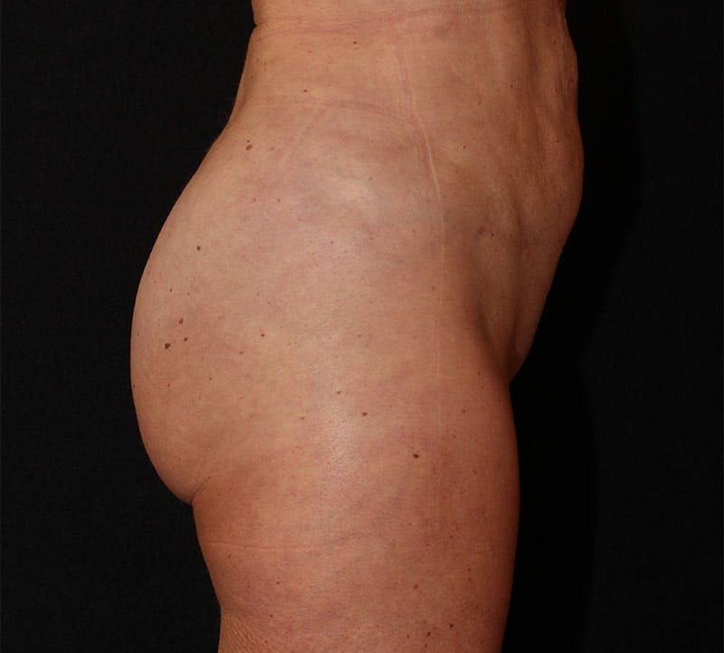 Brazilian Butt Lift Before & After Gallery - Patient 320790 - Image 6
