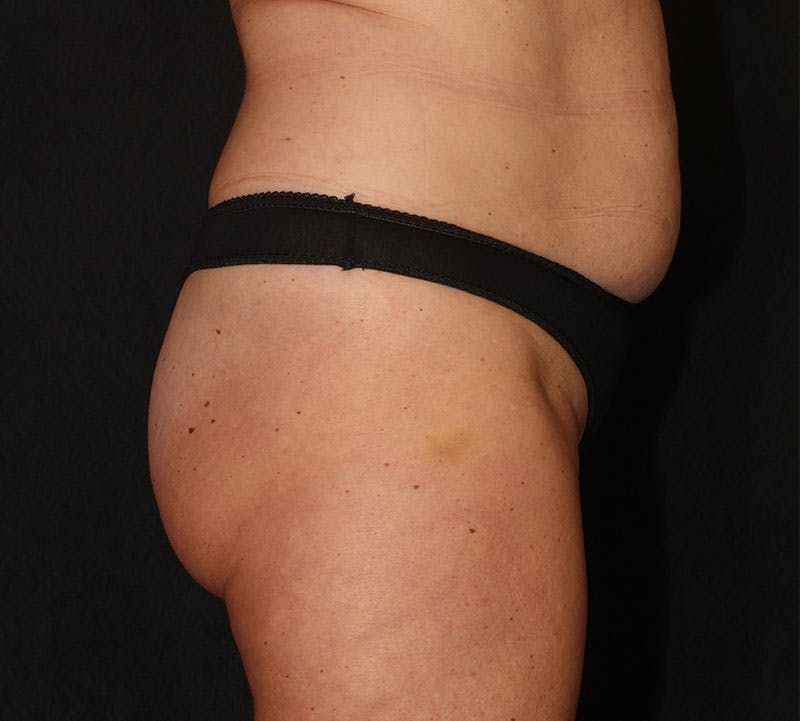 Brazilian Butt Lift Before & After Gallery - Patient 320790 - Image 5