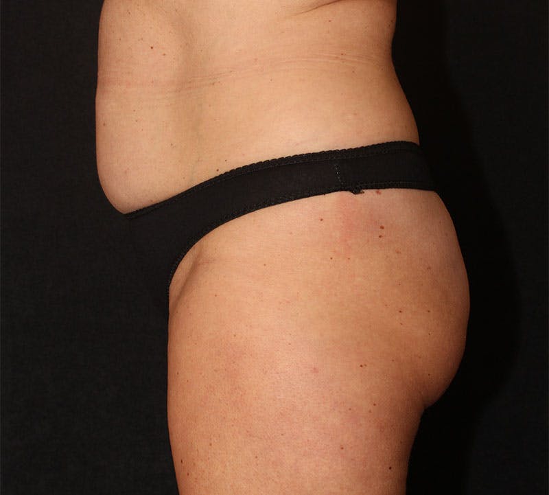 Brazilian Butt Lift Before & After Gallery - Patient 320790 - Image 9
