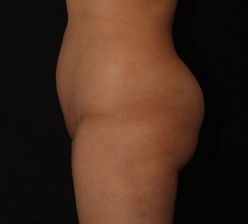 Brazilian Butt Lift Before & After Gallery - Patient 361384 - Image 10