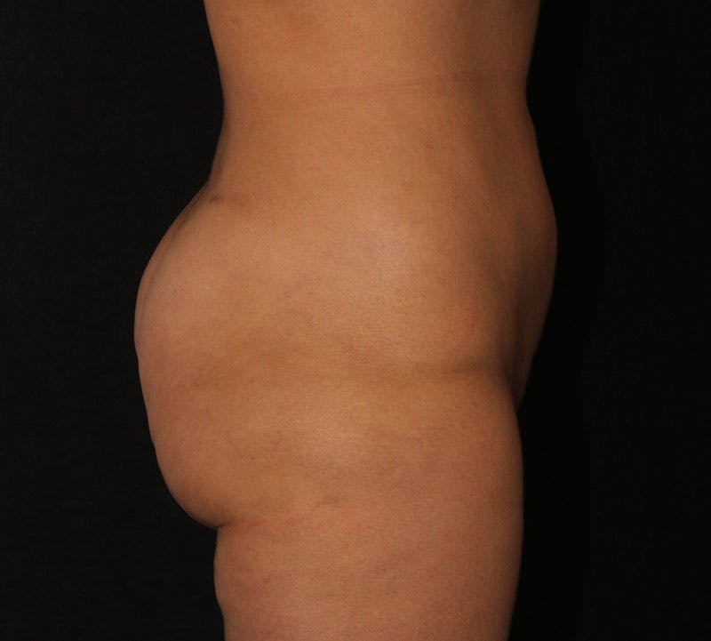 Brazilian Butt Lift Before & After Gallery - Patient 361384 - Image 6