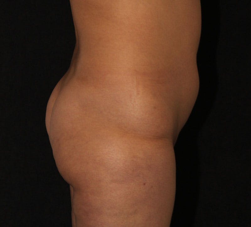 Brazilian Butt Lift Before & After Gallery - Patient 361384 - Image 5