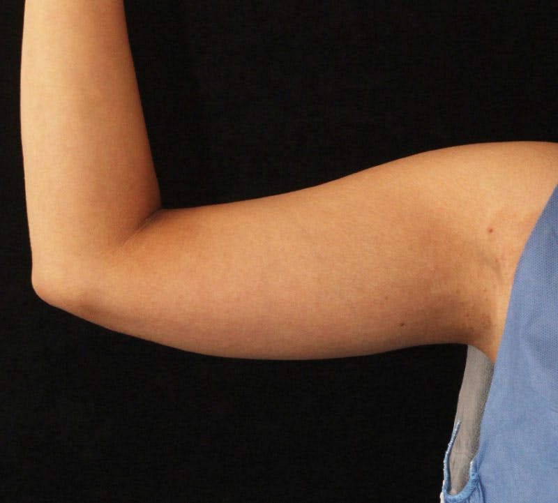 Bodytite Before & After Gallery - Patient 136368 - Image 4