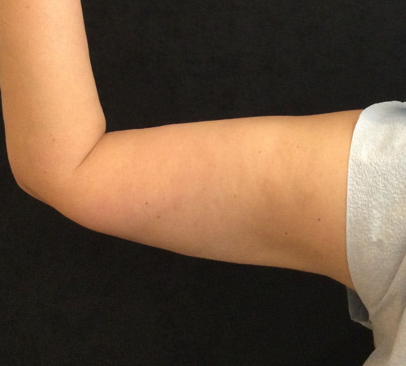 Bodytite Before & After Gallery - Patient 334927 - Image 6
