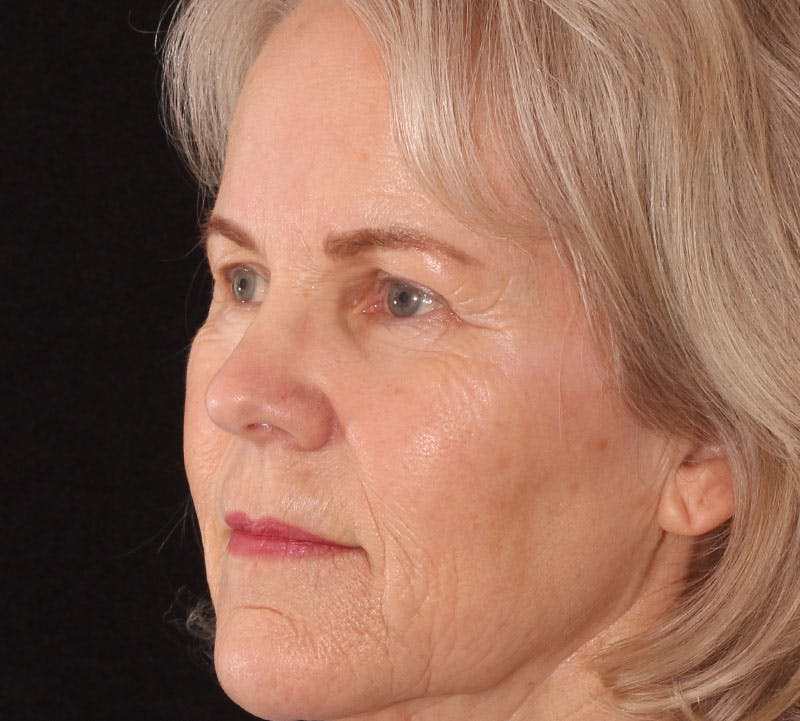 Blepharoplasty Before & After Gallery - Patient 293396 - Image 9