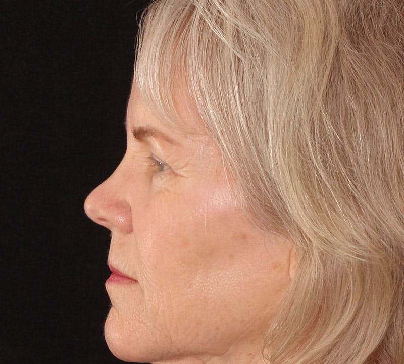 Blepharoplasty Before & After Gallery - Patient 293396 - Image 7
