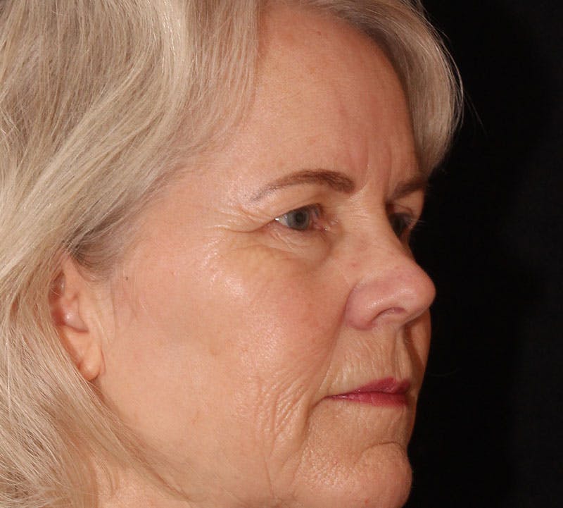 Blepharoplasty Before & After Gallery - Patient 293396 - Image 3