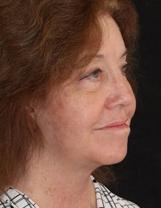 Facelift/Necklift Before & After Gallery - Patient 242516 - Image 4