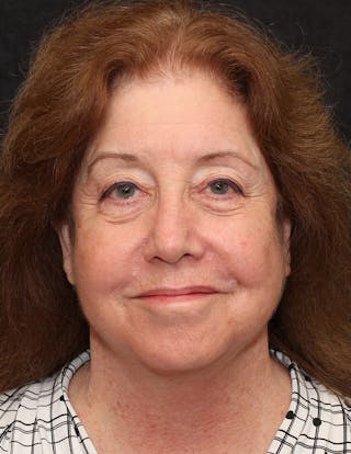 Facelift/Necklift Before & After Gallery - Patient 242516 - Image 2